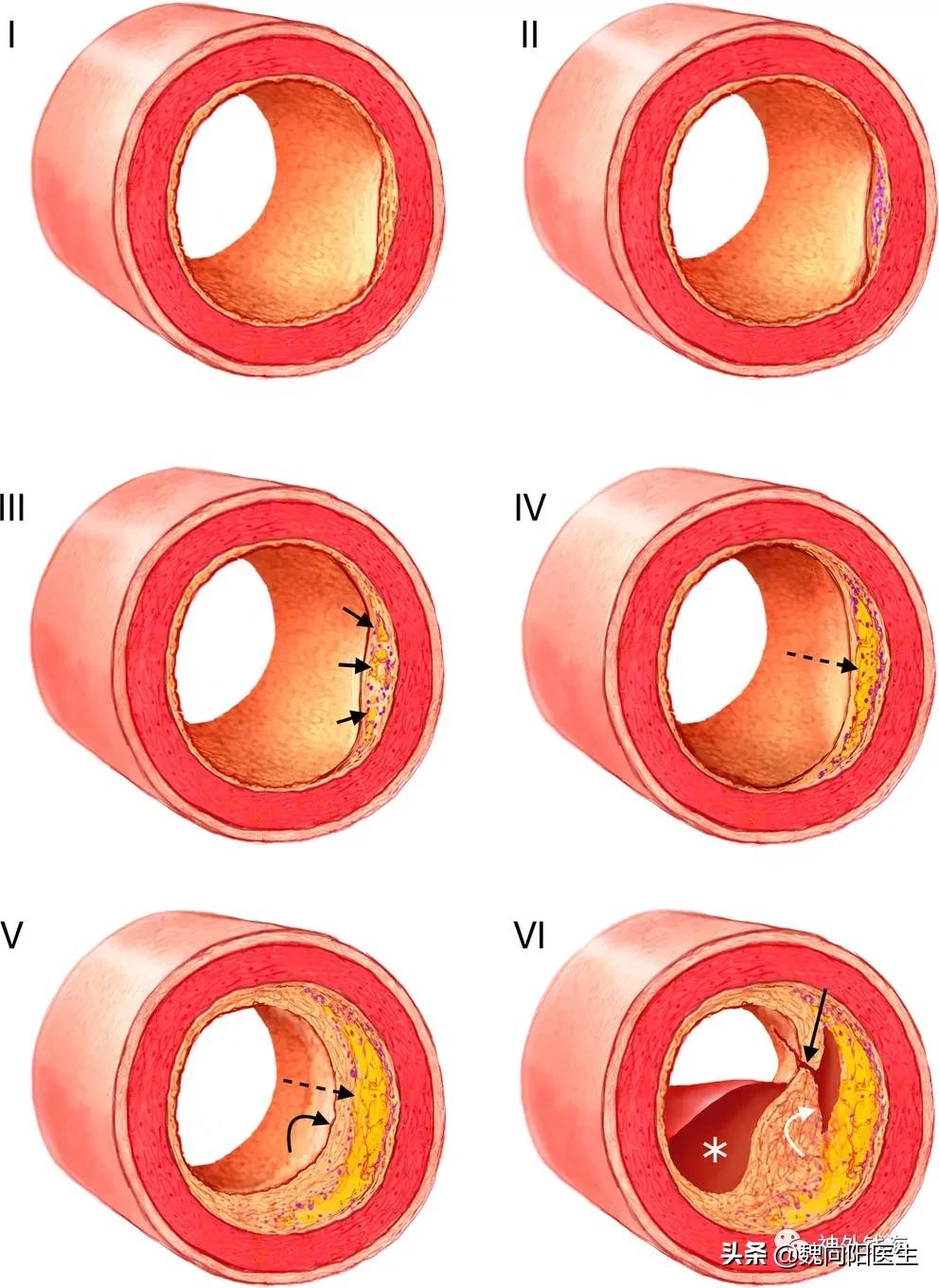 静脉血管装了支架能不能做磁共振,血管支架放不进去怎么办