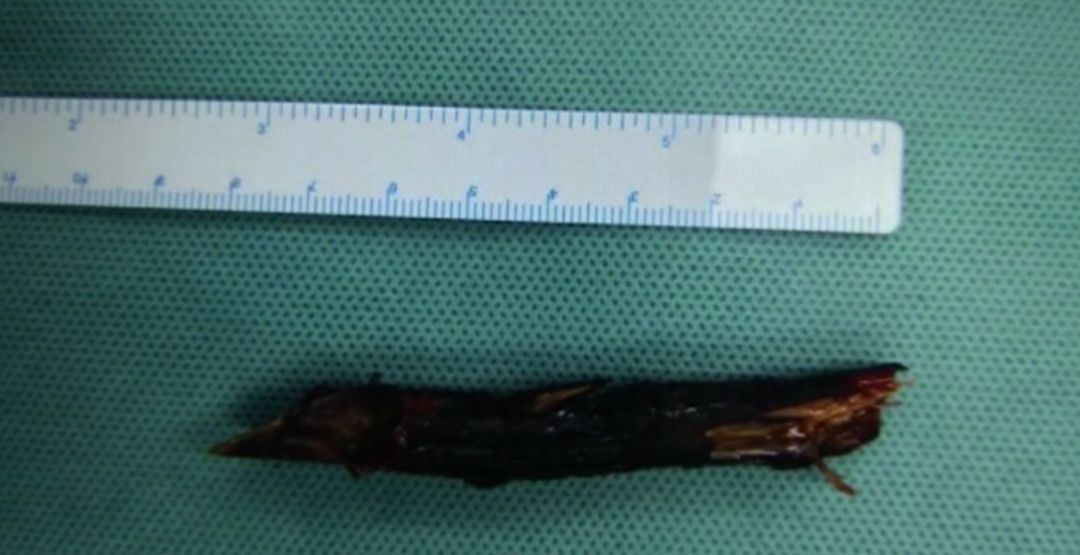 女子脸上长痘流脓,女的脸上流脓