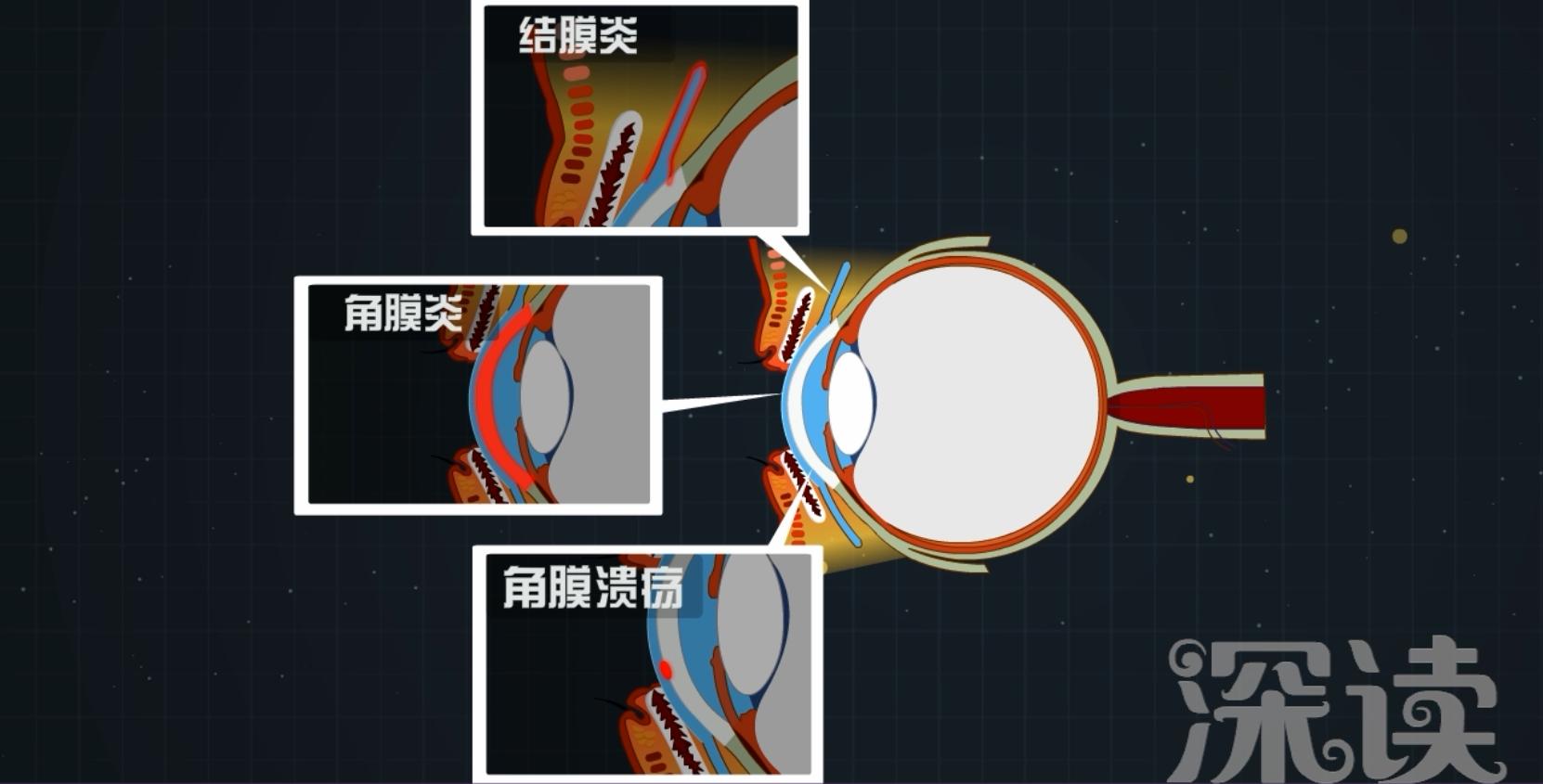 女子熬夜玩手机醒来失明,熬夜加班眼睛模糊怎么办