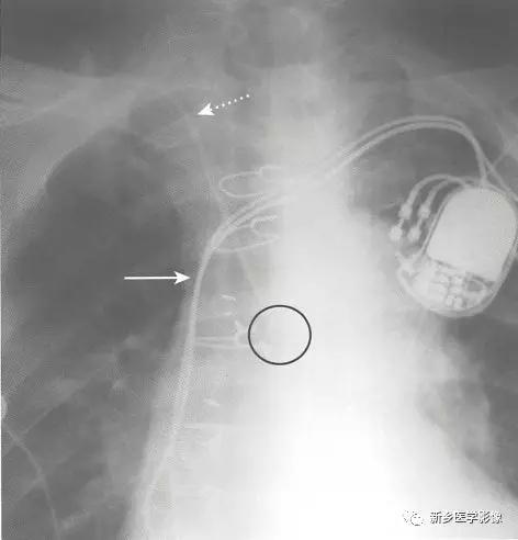 动脉导管未闭胸片表现是什么,血管cta和造影狭窄程度判断
