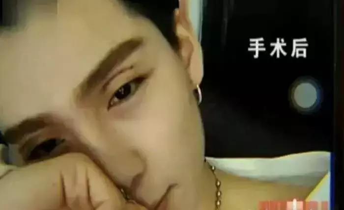 男生割内双眼皮手术,男子去割单眼皮后的结果