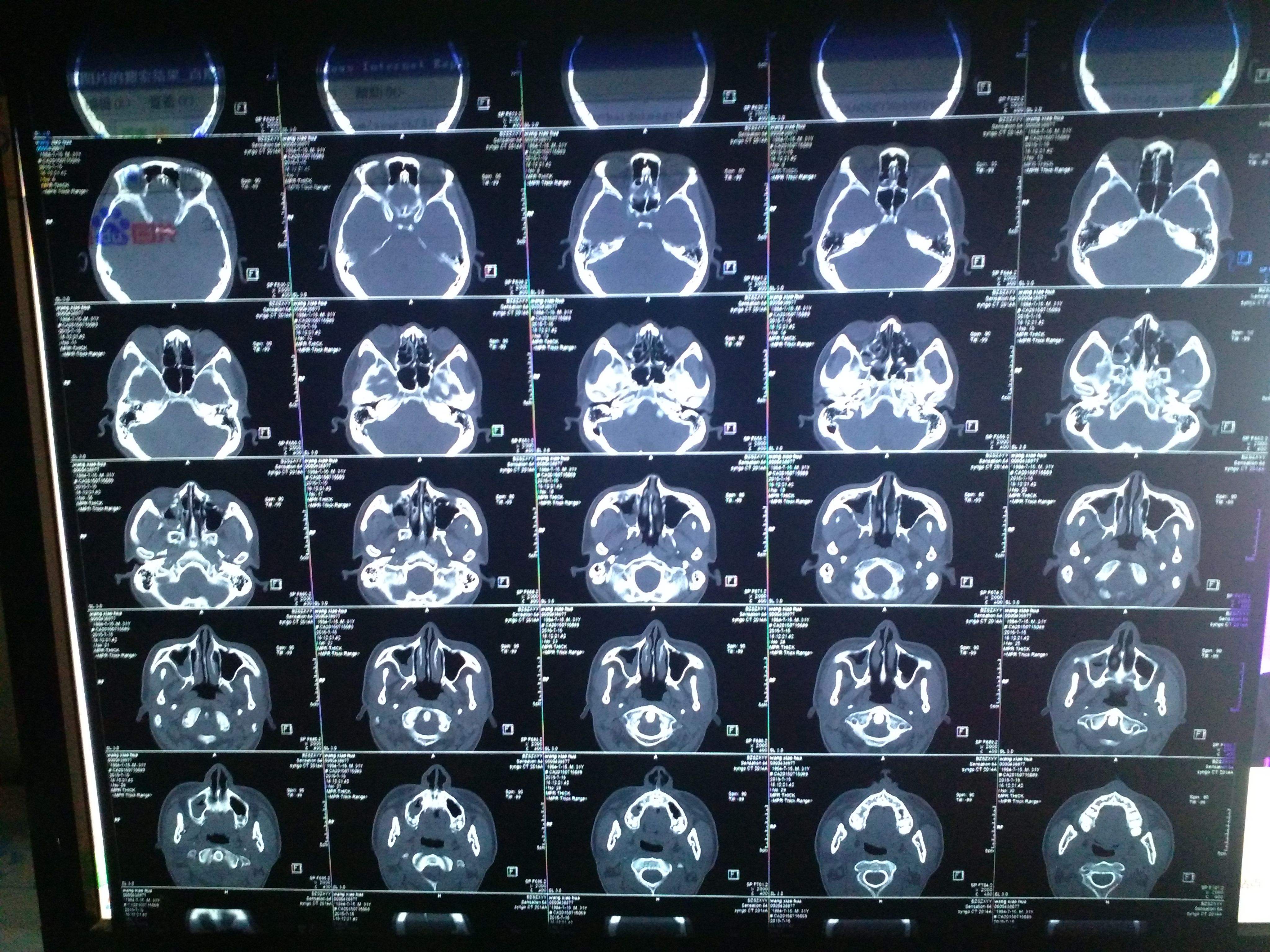 儿童鼻窦炎如何彻底治好,化脓性鼻窦炎可以彻底治好吗