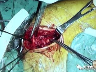 肩锁关节脱位手术后多久可以喝酒,肩锁关节脱位钢板内固定步骤记录