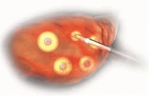 试管婴儿取完卵注意事项,试管婴儿促排多久可以取到卵