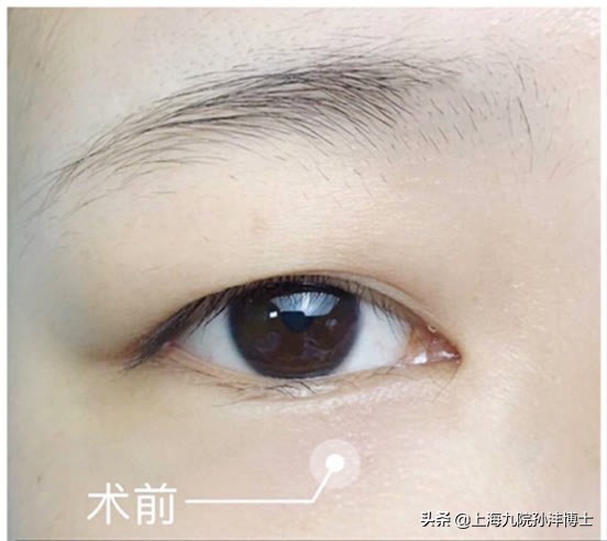 双眼皮修复眼角出现多层疤痕,医生推荐的双眼皮术后祛疤