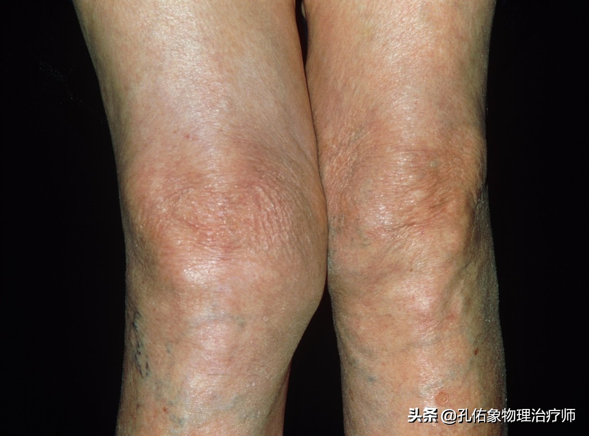 膝盖上下楼梯疼痛蹲下起不来,膝关节上下楼梯下蹲疼痛