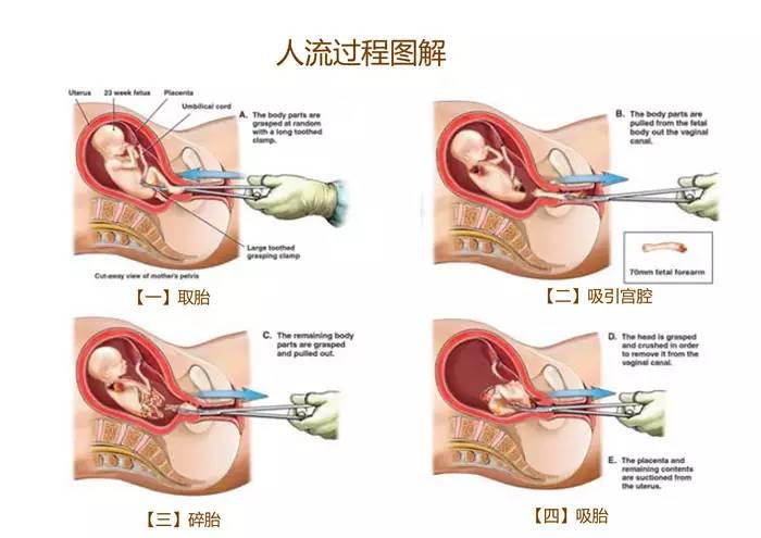 求你们不要再捧无痛人流了