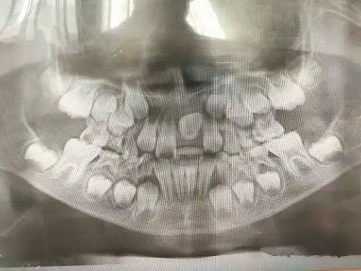 郑州牙齿矫正蔡留意教授：儿童七岁前，牙不疼不用见牙医？