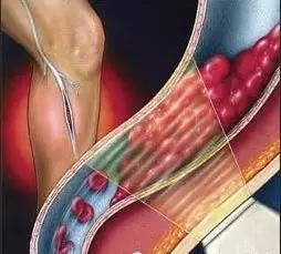 小腿血栓皮肤溃烂创面怎么处理,皮肤血管坏死怎么回事