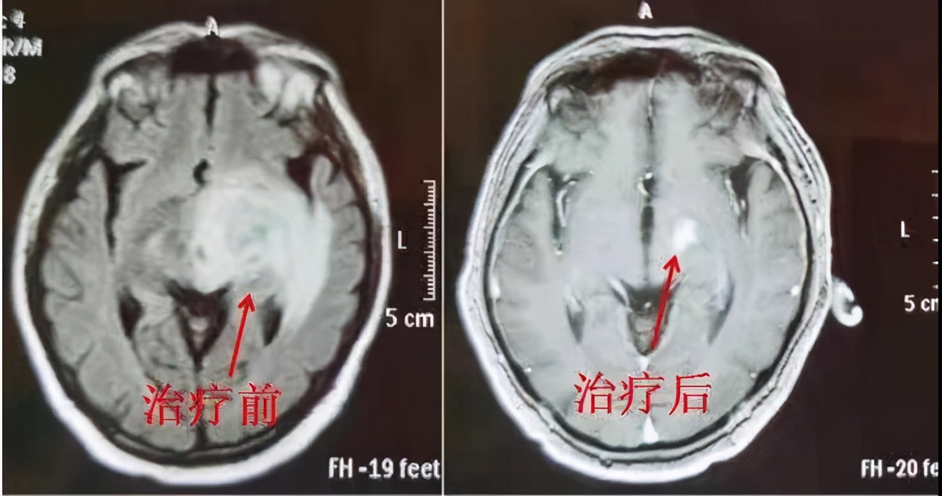 淋巴瘤能靶向治疗吗,淋巴瘤的靶向治疗效果