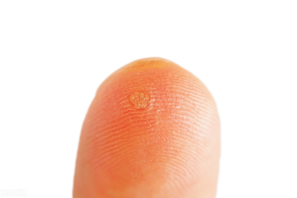 手背上的扁平疣消除最好的方法,儿童扁平疣最简单的去除方法