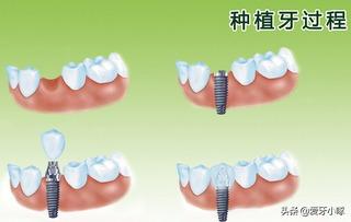 牙齿松动怎么办最快最有效的方法,牙齿松动怎么挽救