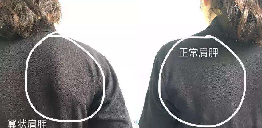 体态大师翼状肩胛要沉肩吗,体态大师翼状肩胛错误动作