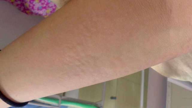 麻疹成因,荨麻疹形成的各种原因具体介绍