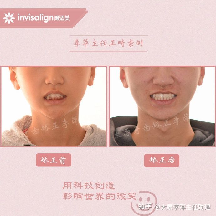 重度拥挤矫正牙齿适合隐形牙套吗,广州成人牙齿矫正推荐隐形牙套