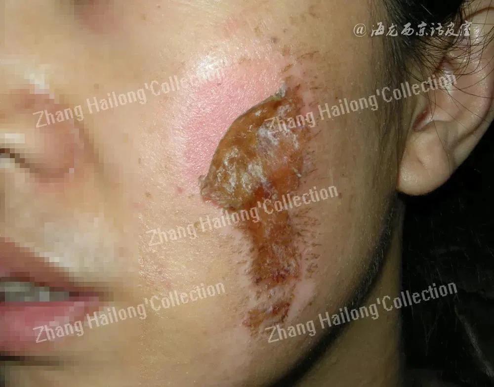 面部擦伤挂什么科,脸部擦伤怎么处理