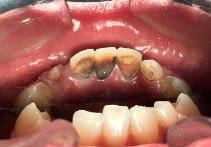 牙齿发黑是什么原因,宝贝牙齿黑了用什么牙膏最好