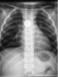 小孩误吞纽扣电池是什么症状,孩子误吞了纽扣电池