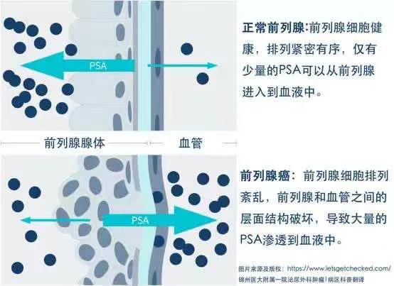 50岁男人psa早期症状,男性检查psa注意事项
