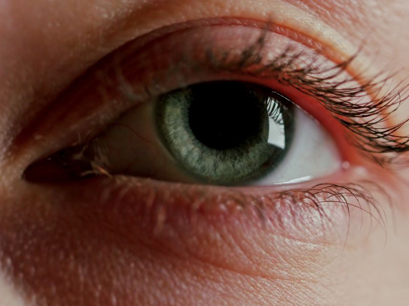 眼睛红有血丝怎么回事,眼睛红有血丝有眼屎