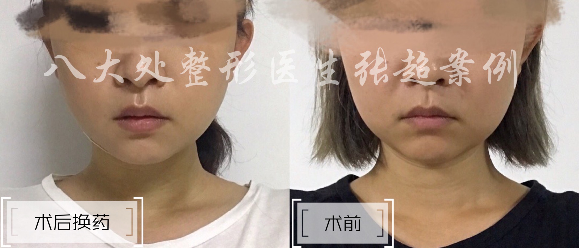 八大处整形张超,八大处张超最新视频