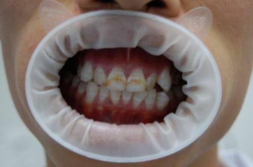 氟元素有什么作用,氟及其无机化合物对身体的危害