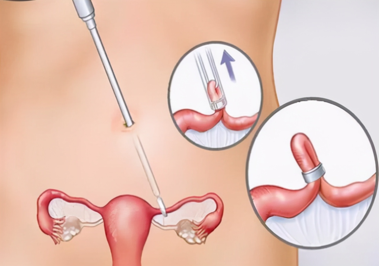 输卵管结扎排出的卵子去哪,输卵管结扎后卵子怎么排出