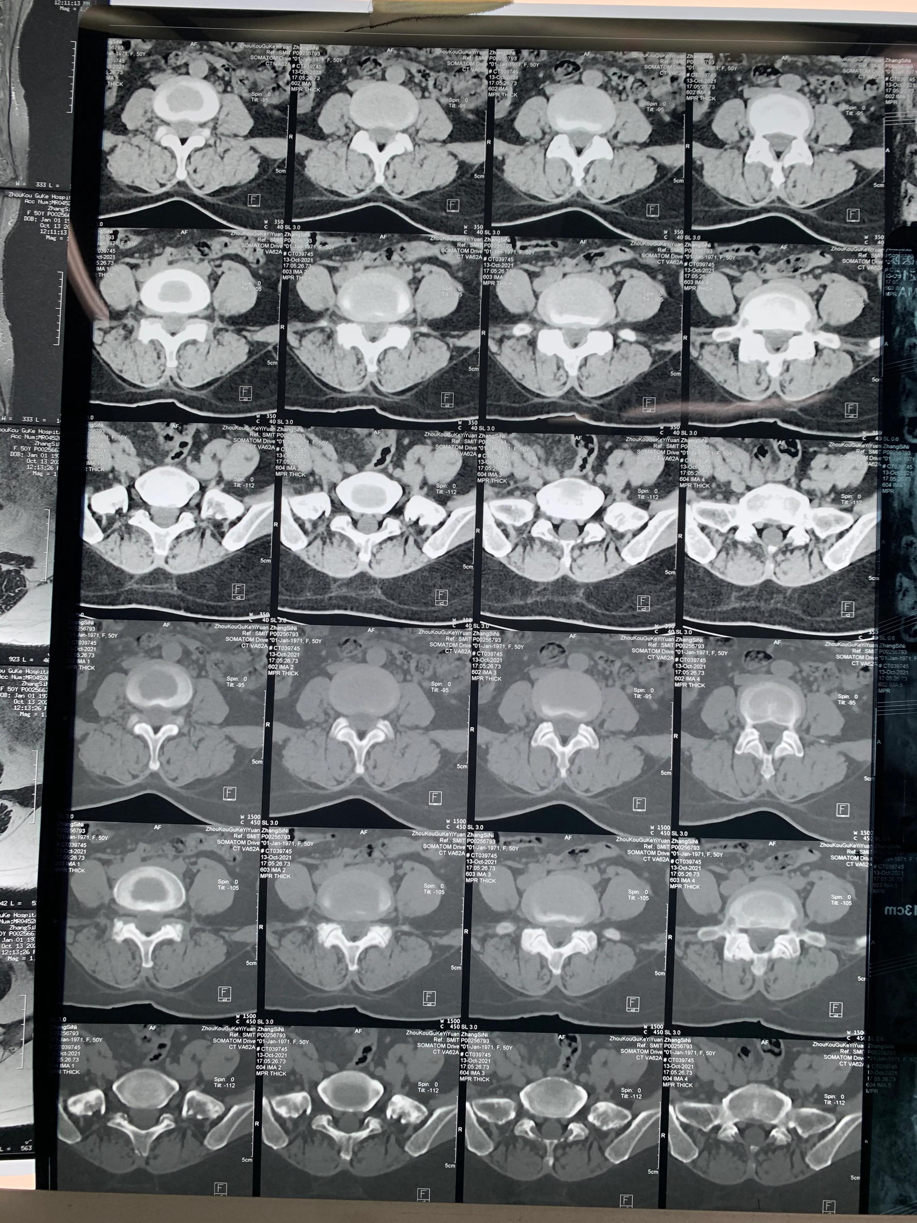 椎间孔镜术后腰痛症状多久消失,盘源性腰痛手术后易复发吗