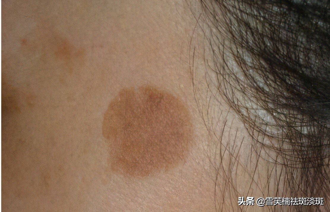 脸上怎么祛斑可靠,吃祛斑药物真能快速祛斑吗