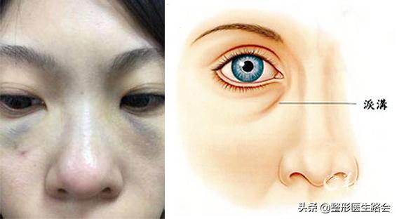 玻尿酸填充泪沟20多天了还有淤青,填充眼袋泪沟的淤青怎么才会消除