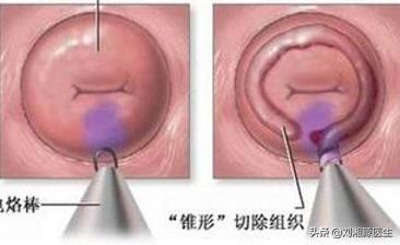 免疫治疗不良妊娠的方法,妊娠合并宫颈机能不全什么原因