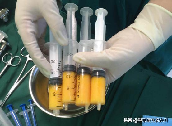 面部填充后吃什么对脂肪存活有利,脂肪填充多久脂肪存活稳定