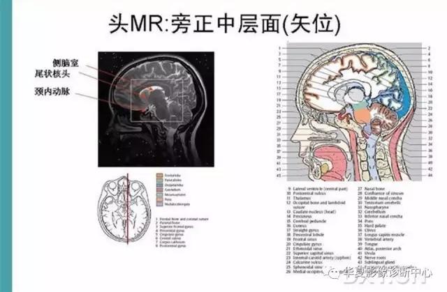 电子版头颅ct与mri断层解剖,头颅mri血管解剖与分段详解