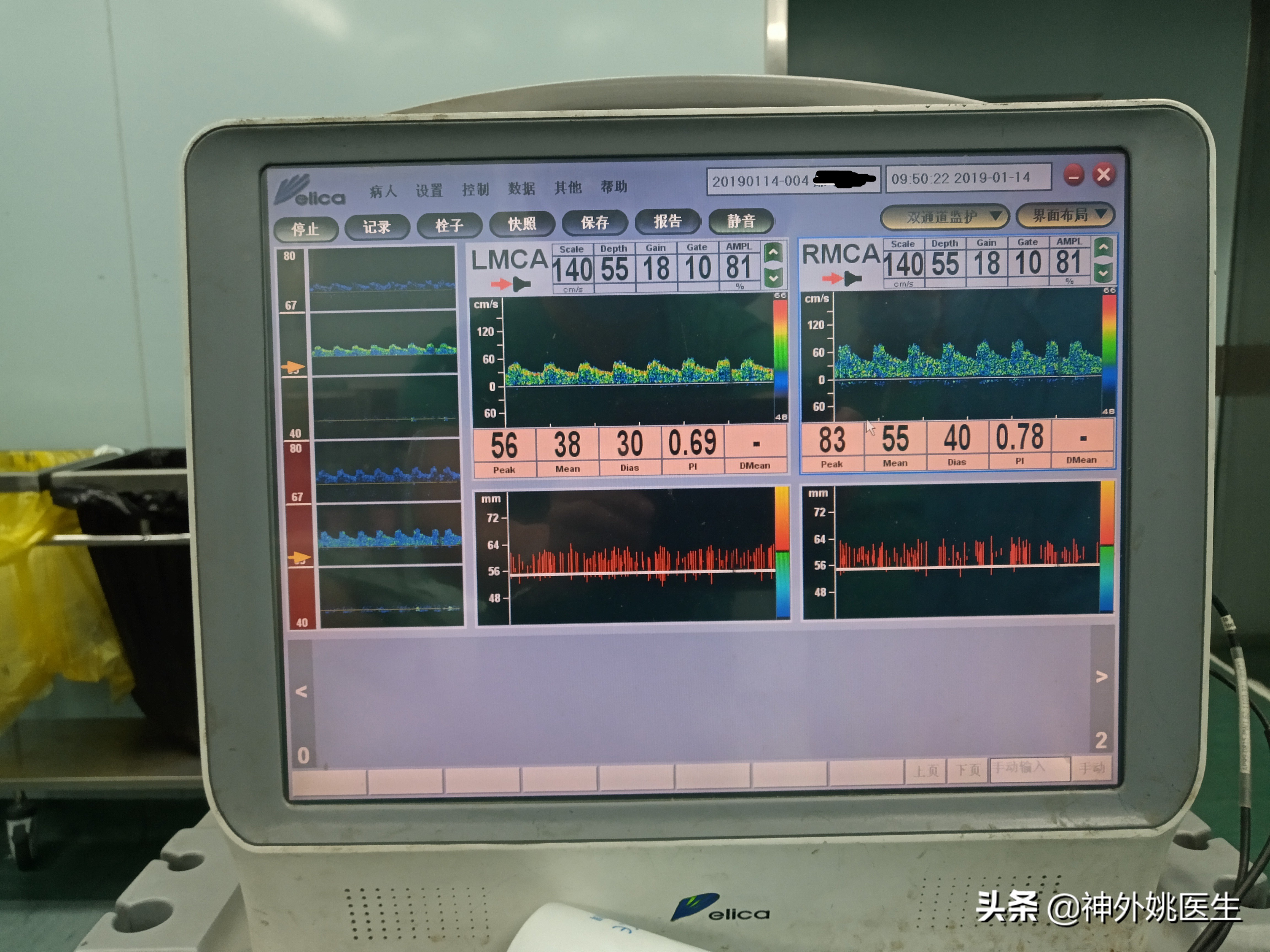 颈内动脉狭窄内膜剥脱术风险大吗,颈动脉内膜摘除手术
