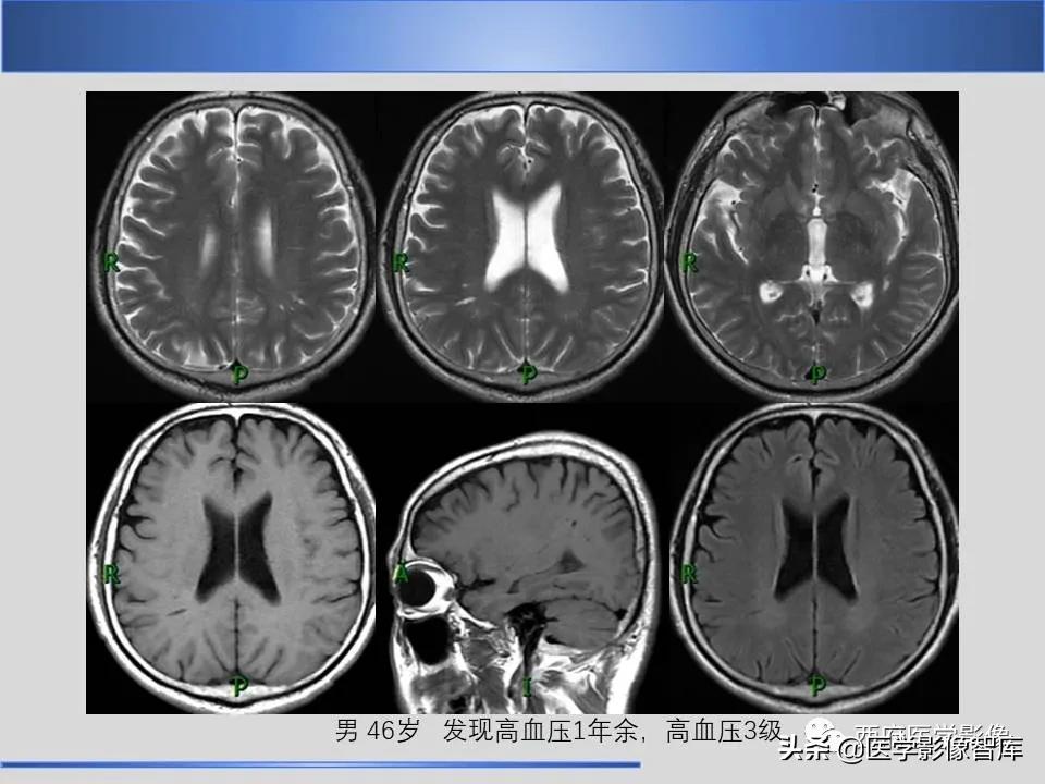 vr间隙概念,vr间隙需要做什么检查
