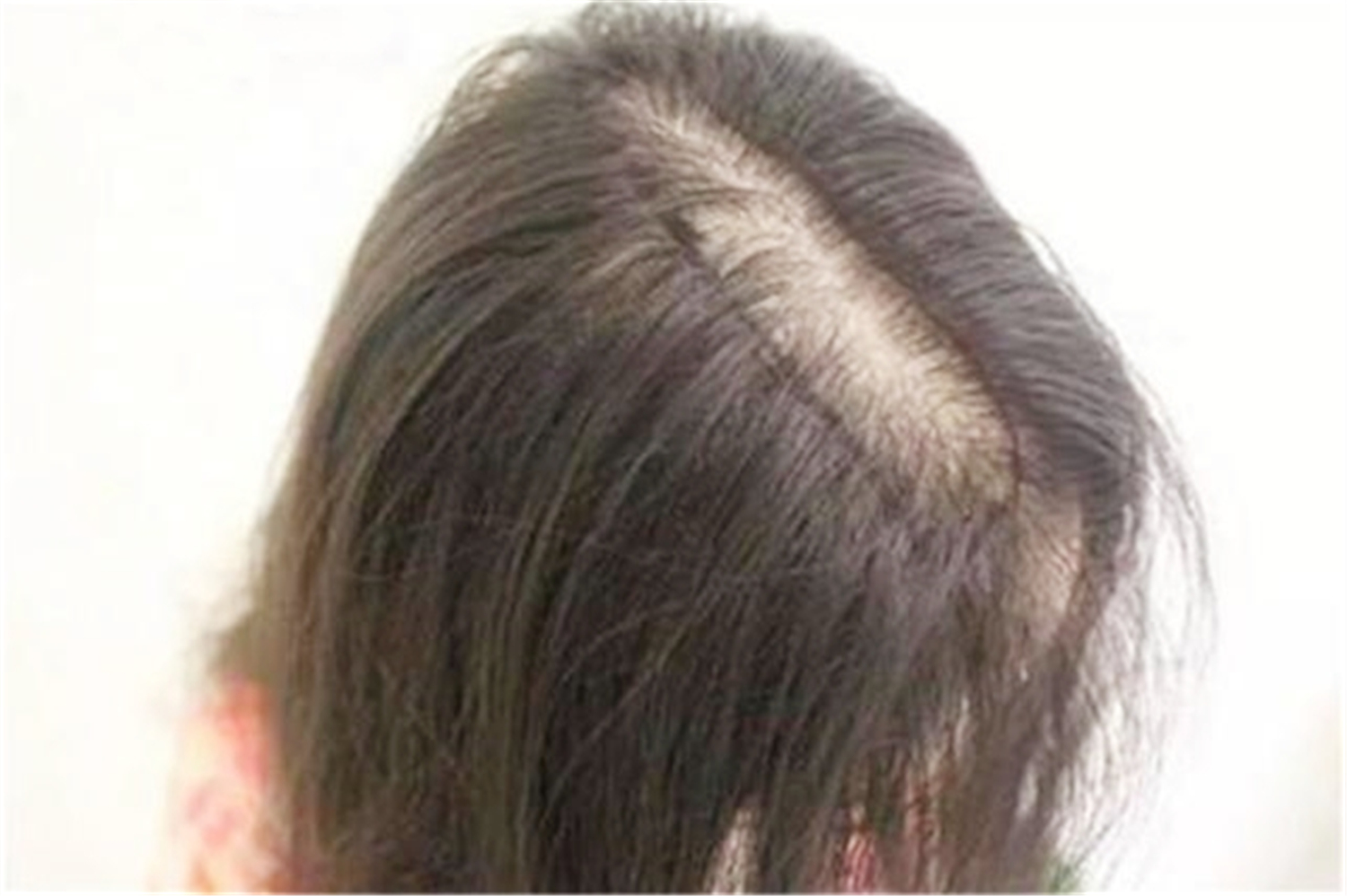 张歆艺产后掉发,张歆艺产后脱发