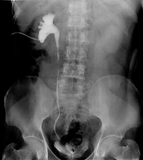 取口腔组织修复输尿管,自体口腔黏膜再造术