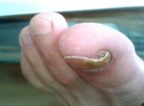 脚趾甲长到肉里一招解决方法贴吧,运动后脚趾甲肿了怎么快速消肿