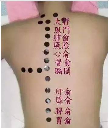 咳嗽拔罐啥穴位,咳嗽止咳最佳拔罐疗法