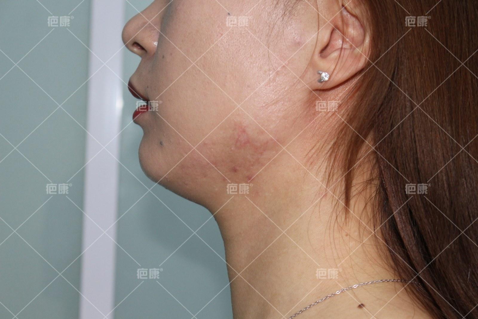 北京疤康对疤痕疙瘩能看好吗,疤康疤痕疙瘩恢复图片