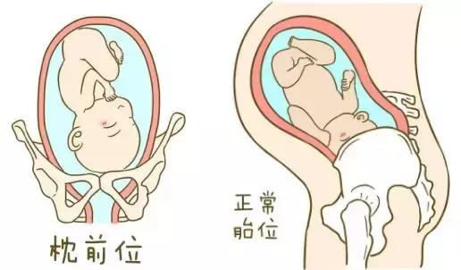 胎位不正可能导致难产？别紧张！了解这些，没你想得那么可怕