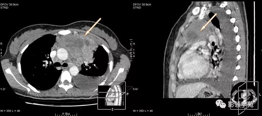 纵隔和肾上腺恶性肿瘤,纵隔性肿瘤位置图