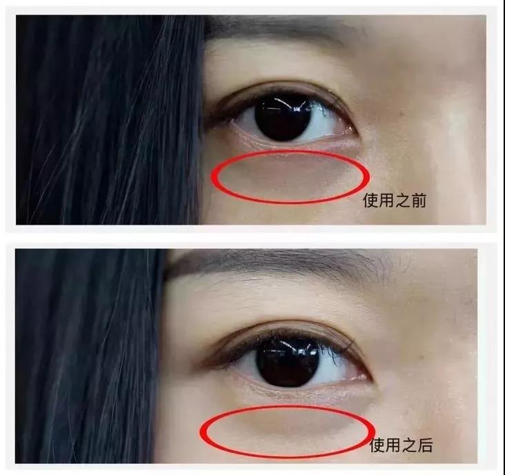 眼睛黑眼圈显老怎么办,眼睛黑眼圈大眼袋怎么消除