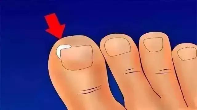 如何取出脚趾甲长进肉里,脚趾甲长进肉里需要拔甲吗