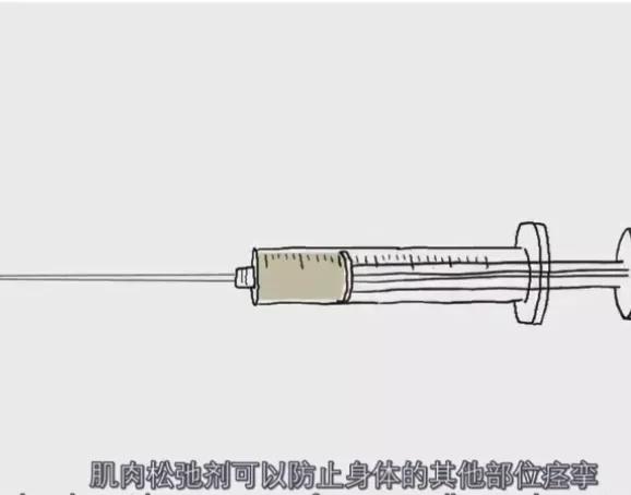 抑郁无抽搐电休克治疗,无抽搐电休克治疗步骤