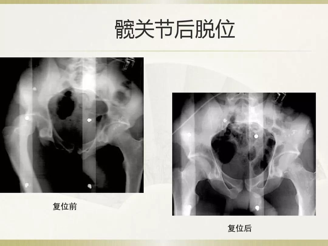 骨科x光片读片技巧,放射科骨科读片教程