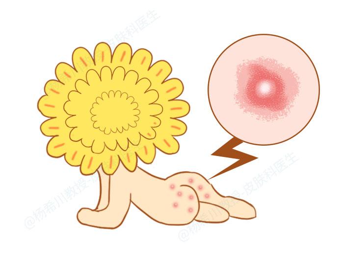 肛门瘙痒反复发作怎么办,肛门瘙痒老反复怎么办