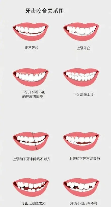 龅牙和深覆合有什么区别,龅牙矫正出现深覆合正常吗