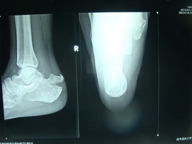脚跟骨折恢复了怎么练习走路,跟骨骨折保守治疗100天多走路好吗