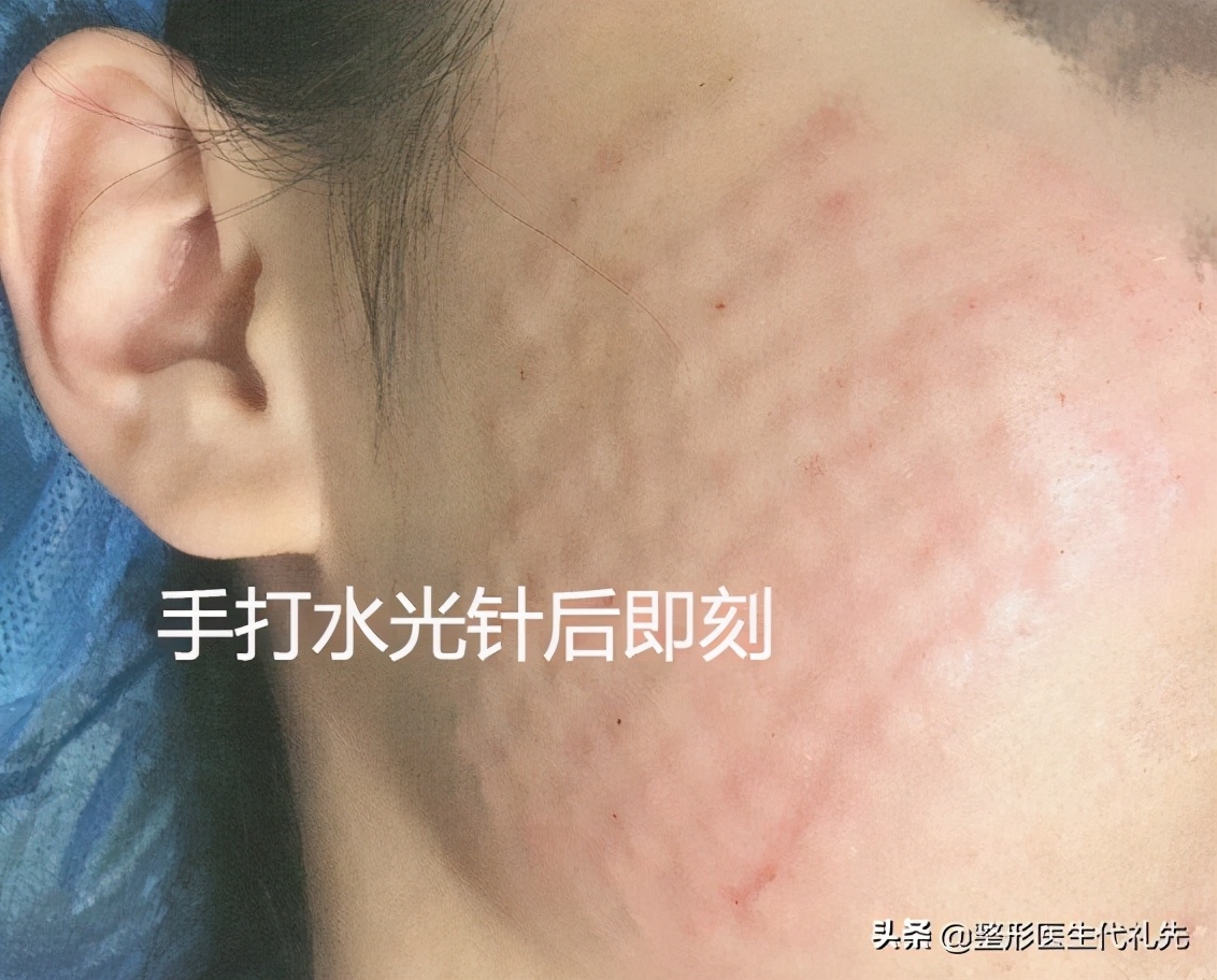 打美白水光针几次可以看到效果,水光针用哪种针注射好